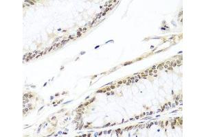Immunohistochemistry of paraffin-embedded Human colon carcinoma using HIRA Polyclonal Antibody at dilution of 1:100 (40x lens).