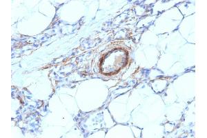 Formalin-fixed, paraffin-embedded human Angiosarcoma stained with SM-MHC Mouse Monoclonal Antibody (MYH11/923). (MYH11 anticorps)