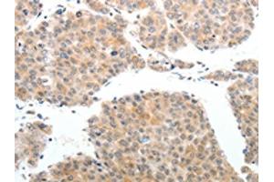 The image on the left is immunohistochemistry of paraffin-embedded Human liver cancer tissue using ABIN7189608(ABL2 Antibody) at dilution 1/25, on the right is treated with synthetic peptide. (ABL2 anticorps)