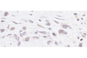 Immunohistochemistry (IHC) image for anti-Polymerase (RNA) III (DNA Directed) Polypeptide B (POLR3B) (AA 1083-1133) antibody (ABIN7453642) (POLR3B anticorps  (AA 1083-1133))