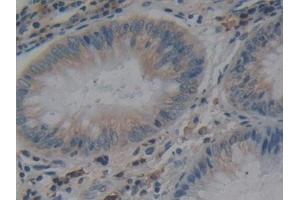 Detection of ACE in Human Colorectal cancer Tissue using Polyclonal Antibody to Angiotensin I Converting Enzyme (ACE)