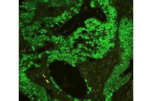 IF analysis of CTBP2 using anti-CTBP2 antibody (ABIN3042768) P-cadherin was detected in paraffin-embedded section of human colon cancer tissues. (CTBP2 anticorps  (AA 321-445))