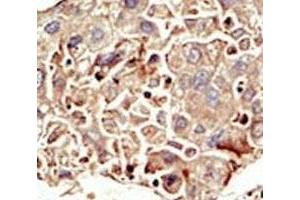 IHC analysis of FFPE human hepatocarcinoma tissue stained with the ALK2 antibody (ACVR1 anticorps  (AA 132-162))