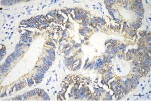 Immunohistochemistry was performed on paraffin-embedded human sigmoid colon carcinoma using catenin beta 1 antibody (ABIN7797927), 1:200).