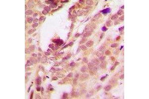 Immunohistochemical analysis of p38 (pT180/Y182) staining in human breast cancer formalin fixed paraffin embedded tissue section. (MAPK14 anticorps  (pThr180, pTyr182))