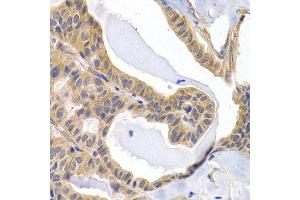Immunohistochemistry of paraffin-embedded human thyroid cancer using PTGIR antibody at dilution of 1:200 (400x lens). (Prostacyclin Receptor anticorps)