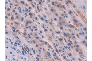 Detection of ACVR2A in Human Liver cancer Tissue using Polyclonal Antibody to Activin A Receptor Type II A (ACVR2A)