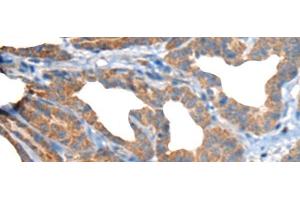 Immunohistochemistry of paraffin-embedded Human thyroid cancer tissue using RTN4IP1 Polyclonal Antibody at dilution of 1:50(x200) (RTN4IP1 anticorps)