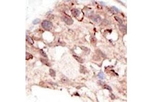 Formalin-fixed and paraffin-embedded human cancer tissue reacted with the primary antibody, which was peroxidase-conjugated to the secondary antibody, followed by DAB staining.