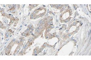 ABIN6278390 at 1/100 staining Human prostate tissue by IHC-P. (EIF3B anticorps)