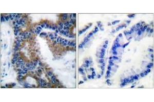 Immunohistochemistry analysis of paraffin-embedded human lung carcinoma, using CrkL (Phospho-Tyr207) Antibody. (CrkL anticorps  (pTyr207))