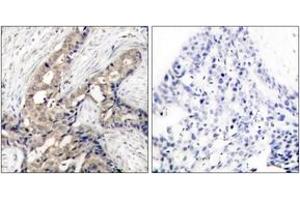 Immunohistochemistry analysis of paraffin-embedded human breast carcinoma, using Abl (Phospho-Tyr393/412) Antibody. (ABL1 anticorps  (pTyr393))