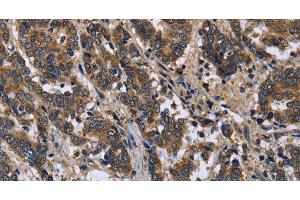 Immunohistochemistry of paraffin-embedded Human liver cancer using FRK Polyclonal Antibody at dilution of 1:50 (FRK anticorps)