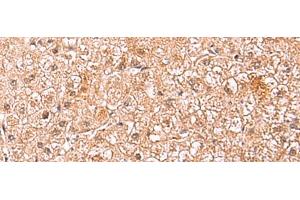 Immunohistochemistry of paraffin-embedded Human liver cancer tissue using ASTN2 Polyclonal Antibody at dilution of 1:80(x200) (Astrotactin 2 anticorps)