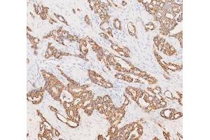 IHC analysis of Cytokeratin 19 using anti-Cytokeratin 19 antibody (ABIN3043288).