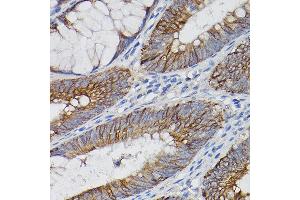 Immunohistochemistry of paraffin-embedded human colon carcinoma using IL18R1/IL-18 R alpha Rabbit pAb (ABIN3023690, ABIN3023691, ABIN3023692 and ABIN6219764) at dilution of 1:150 (40x lens).