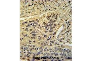 TAF2 Antibody (C-Term) (ABIN653923 and ABIN2843157) immunohistochemistry analysis in formalin fixed and paraffin embedded human lung carcinoma followed by peroxidase conjugation of the secondary antibody and DAB staining. (TAF2 anticorps  (C-Term))