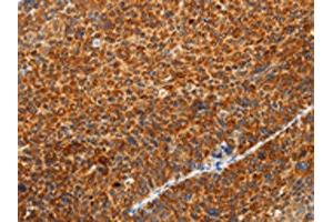 The image on the left is immunohistochemistry of paraffin-embedded Human liver cancer tissue using ABIN7131154(SPATA13 Antibody) at dilution 1/20, on the right is treated with fusion protein. (SPATA13 anticorps)