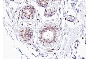 ABIN6267276 at 1/100 staining human Breast carcinoma tissue sections by IHC-P.