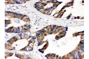 Anti- DLD Picoband antibody, IHC(P) IHC(P): Human Intestinal Cancer Tissue (DLD anticorps  (AA 300-509))