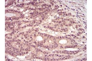 Immunohistochemical analysis of paraffin-embedded colon cancer tissues using PKN1 mouse mAb with DAB staining. (PKN1 anticorps  (AA 442-620))