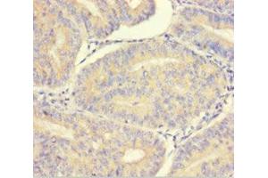 Immunohistochemistry of paraffin-embedded human endometrial cancer using ABIN7165325 at dilution of 1:100