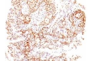 Formalin-fixed, paraffin-embedded human ovarian carcinoma stained with Estrogen Receptor beta antibody (ESR2/686). (ESR2 anticorps  (C-Term))
