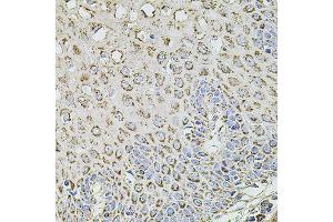 Immunohistochemistry of paraffin-embedded human esophagus using TMC1 antibody (ABIN5996250) at dilution of 1/100 (40x lens). (TMC1 anticorps)