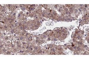 ABIN6273970 at 1/100 staining Human liver cancer tissue by IHC-P. (OR1J4 anticorps  (C-Term))