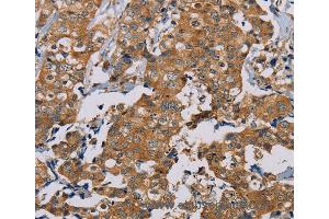 Immunohistochemistry of Human thyroid cancer using TAB3 Polyclonal Antibody at dilution of 1:35