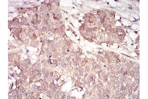 Immunohistochemical analysis of paraffin-embedded bladder cancer tissues using CCNA2 mouse mAb with DAB staining. (Cyclin A anticorps  (AA 105-233))