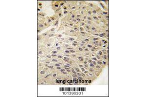 Formalin-fixed and paraffin-embedded human lung carcinoma tissue reacted with GJB5 Antibody , which was peroxidase-conjugated to the secondary antibody, followed by DAB staining.