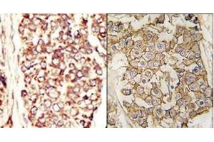 (LEFT)Formalin-fixed and paraffin-embedded human cancer tissue reacted with the primary antibody, which was peroxidase-conjugated to the secondary antibody, followed by AEC staining.