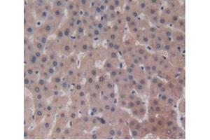 IHC-P analysis of Human Liver Cancer Tissue, with DAB staining. (ALT anticorps  (AA 255-496))