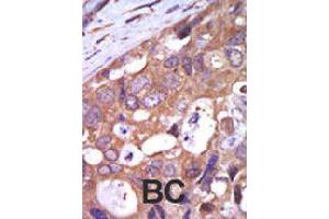 Formalin-fixed and paraffin-embedded human cancer tissue reacted with PRKD1 polyclonal antibody  , which was peroxidase-conjugated to the secondary antibody, followed by AEC staining . (PKC mu anticorps  (N-Term))