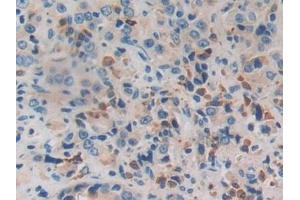 Detection of PRSS2 in Human Prostate cancer Tissue using Polyclonal Antibody to Protease, Serine 2 (PRSS2)