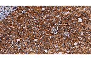 Immunohistochemistry of paraffin-embedded Human cervical cancer tissue using CYP2W1 Polyclonal Antibody at dilution 1:60