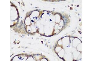 Immunohistochemistry of paraffin-embedded Human gastric using MTDH Polyclonal Antibody at dilution of 1:200 (40x lens).