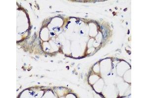 Immunohistochemistry of paraffin-embedded Human gastric using MTDH Polyclonal Antibody at dilution of 1:200 (40x lens). (MTDH anticorps)