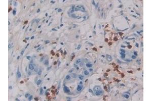 Detection of IL6 in Human Breast cancer Tissue using Monoclonal Antibody to Interleukin 6 (IL6)