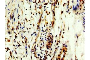 IHC image of ABIN7160441 diluted at 1:300 and staining in paraffin-embedded human bladder cancer performed on a Leica BondTM system. (MYT1 anticorps  (AA 317-451))