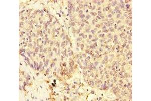 Immunohistochemistry of paraffin-embedded human ovarian cancer using ABIN7174302 at dilution of 1:100 (USP28 anticorps  (AA 430-580))
