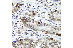 Immunohistochemistry of paraffin-embedded human gastric cancer using DR1 antibody at dilution of 1:100 (x40 lens).