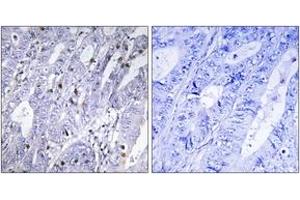 Immunohistochemistry analysis of paraffin-embedded human colon carcinoma tissue, using MEF2D (Ab-444) Antibody. (MEF2D anticorps  (AA 410-459))