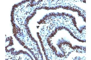 Formalin-fixed, paraffin-embedded human Ovarian Carcinoma stained with Histone H1 Monoclonal Antibody (AE-4)