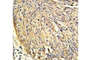Annexin A1 antibody IHC analysis in formalin fixed and paraffin embedded human lung carcinoma.