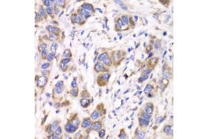 Immunohistochemistry of paraffin-embedded human esophageal cancer using ALDH2 antibody. (ALDH2 anticorps)