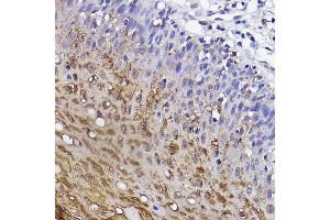 Immunohistochemistry of paraffin-embedded human cervical using SSC/SerpinB3 Rabbit mAb (ABIN7270242) at dilution of 1:100 (40x lens). (SERPINB3 anticorps)