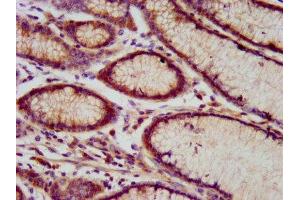 IHC image of ABIN7151176 diluted at 1:800 and staining in paraffin-embedded human gastric cancer performed on a Leica BondTM system. (RNF213 anticorps  (AA 202-350))