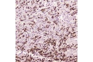 IHC testing of FFPE human gastric cancer with Cathepsin E antibody at 2ug/ml.